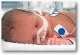 prematuur geboren baby